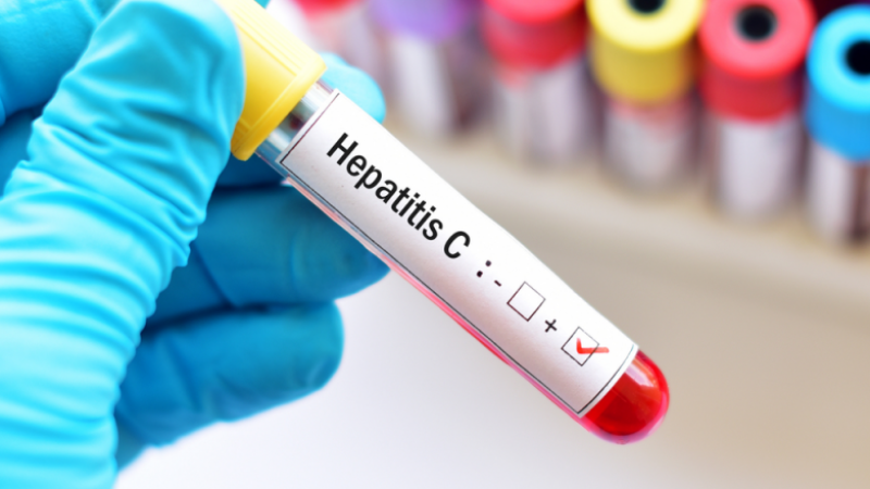 hepatit-c-oldugumuzu-hardan-bilek-mutleq-oxuyun-1729609171