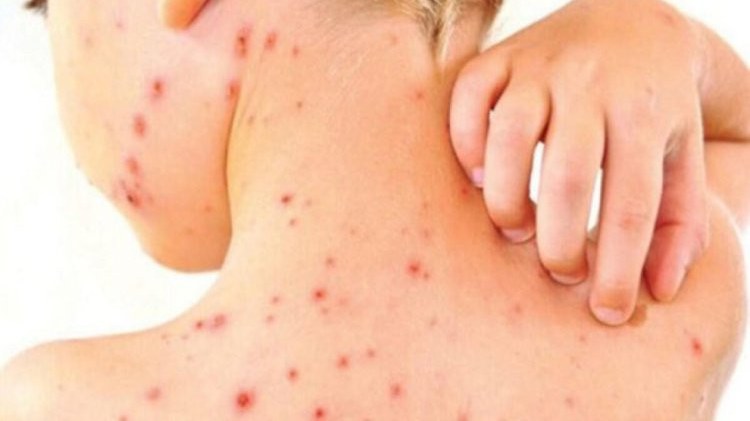 qizilca-epidemiyasi-yayilir-xeste-sayi-1000-e-yaxinlasir-1746384220