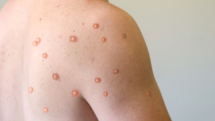nbspm-pox-virusundan-ilk-olum-qeyde-alindi-1753683778